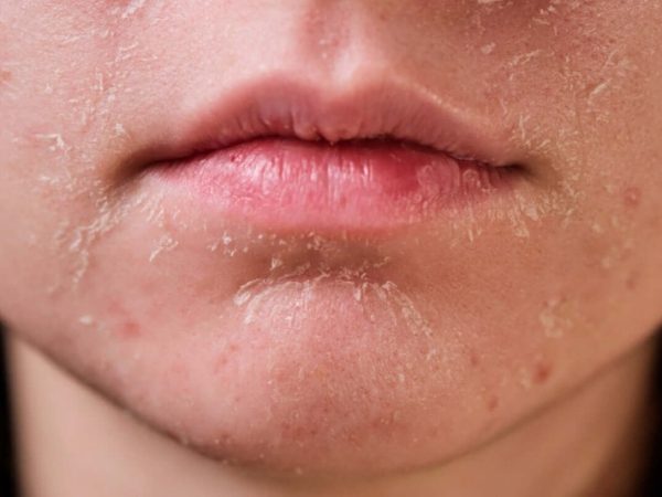 Cara Rawat Kulit Kering Supaya Kembali Lembap & Berseri