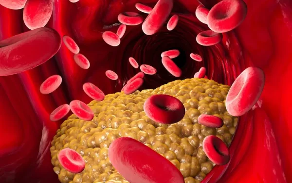 Tanda Hyperkolesterol Yang Ramai Tak Sedar – Senyap Tapi Bahaya