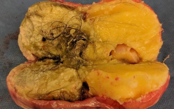 Cara Kecilkan Cyst Secara Semulajadi: Panduan Lengkap Untuk Wanita