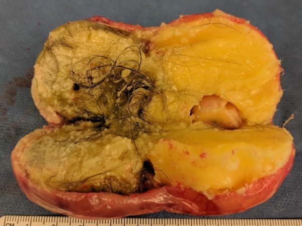 Cara Kecilkan Cyst Secara Semulajadi: Panduan Lengkap Untuk Wanita