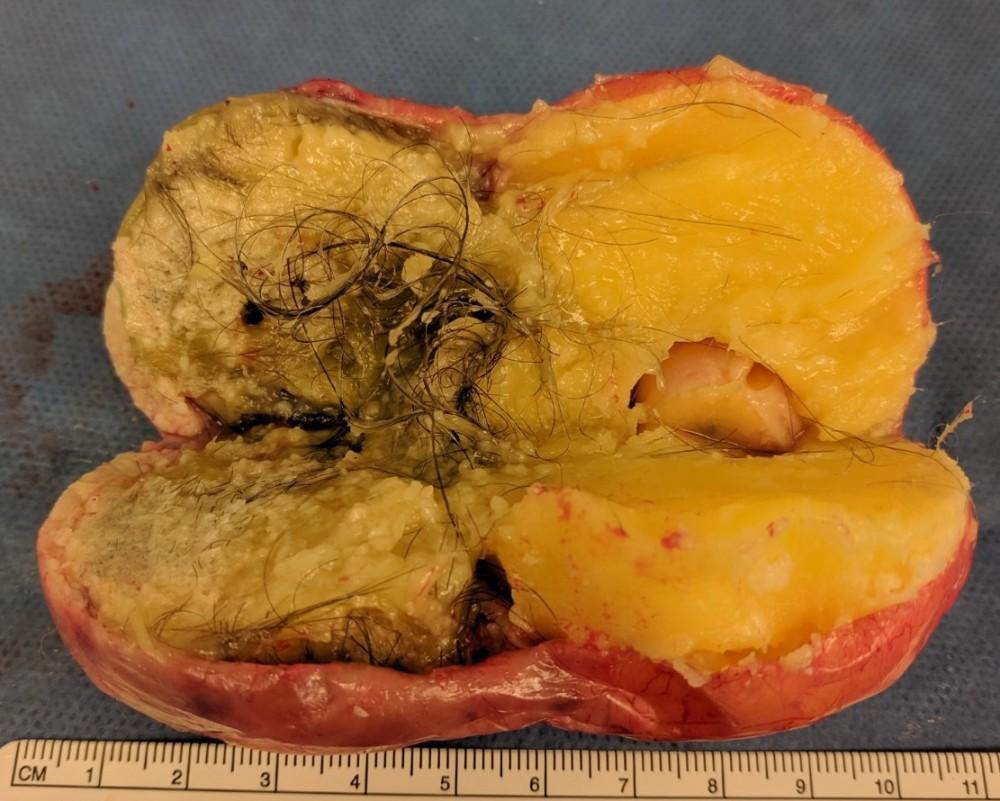 Cara Kecilkan Cyst Secara Semulajadi: Panduan Lengkap Untuk Wanita