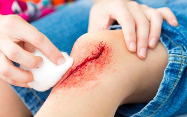 Vitamin Untuk Luka Cepat Sembuh