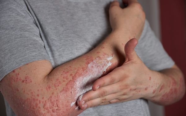 Suplemen Untuk Autoimmune: Nutrisi Yang Boleh Menyokong Kesihatan Pesakit Autoimun