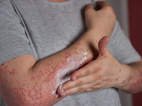 Suplemen Untuk Autoimmune: Nutrisi Yang Boleh Menyokong Kesihatan Pesakit Autoimun
