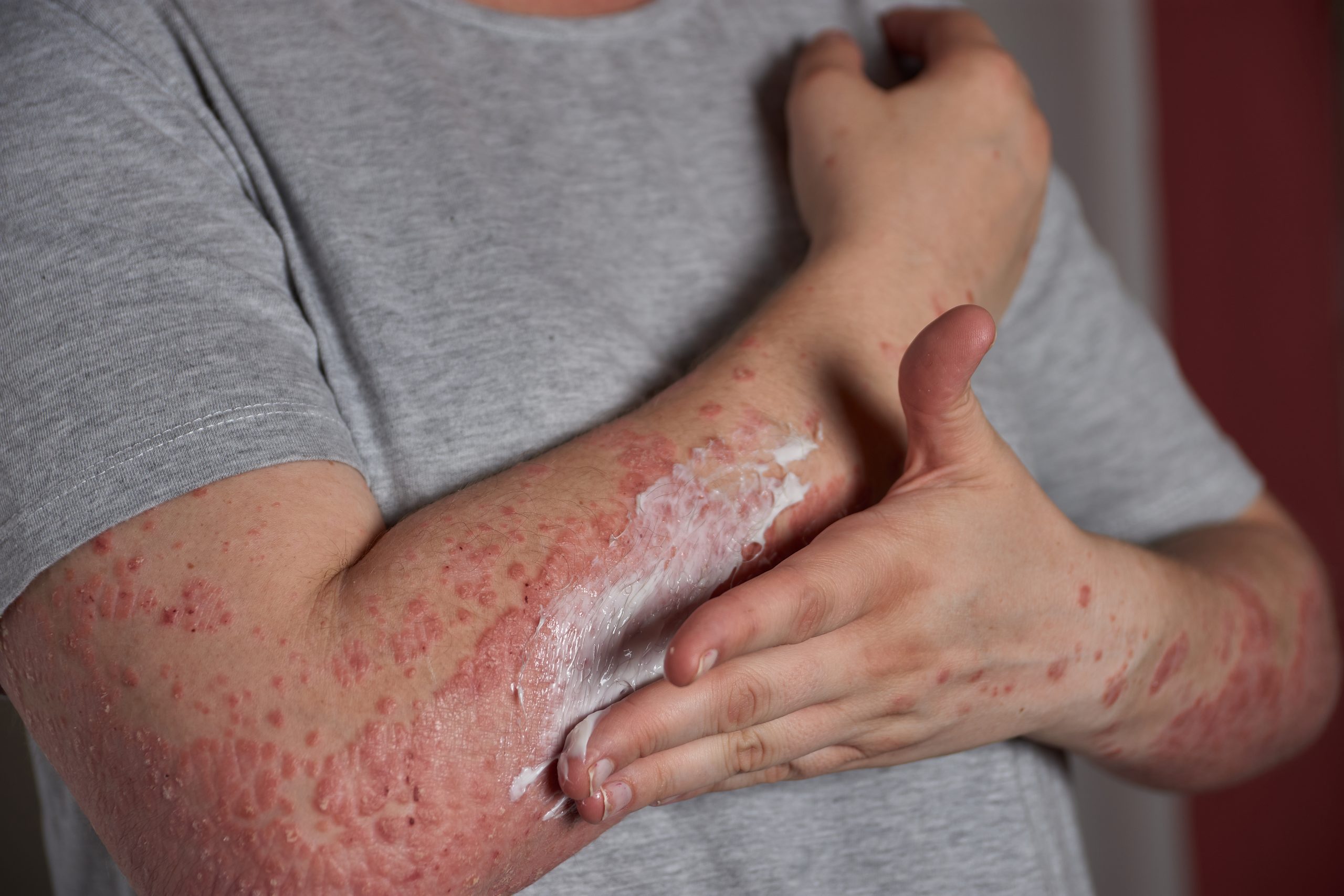 Suplemen Untuk Autoimmune: Nutrisi Yang Boleh Menyokong Kesihatan Pesakit Autoimun