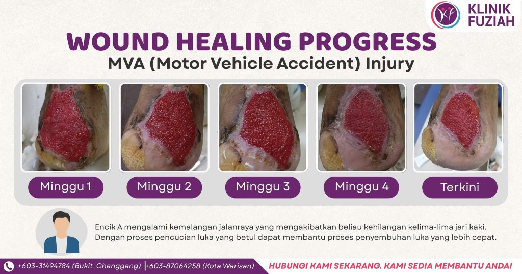 Luka Kemalangan Cepat Sembuh 