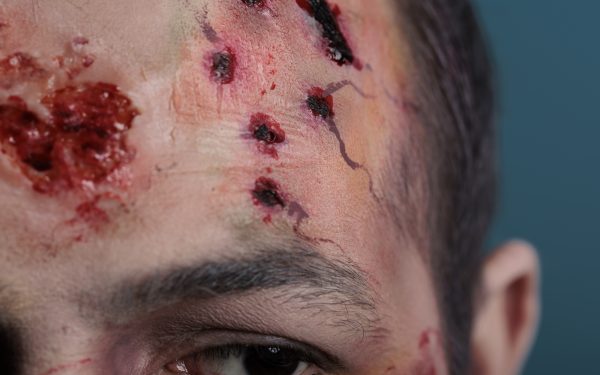 Luka Kemalangan Cepat Sembuh Dengan Vivix? Ini Yang Anda Perlu Tahu