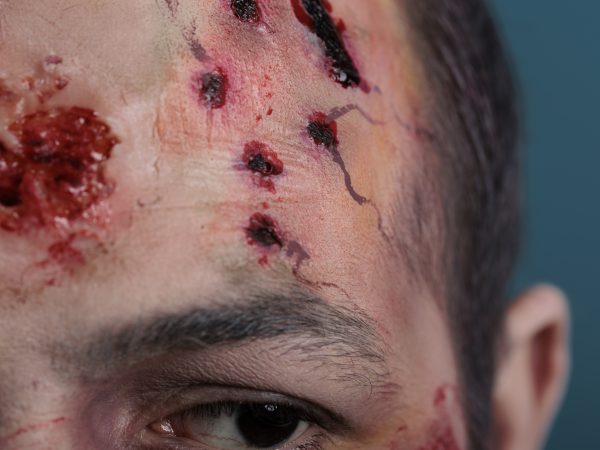 Luka Kemalangan Cepat Sembuh Dengan Vivix? Ini Yang Anda Perlu Tahu